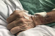 A close-up pf an elderly person's hand with an IV line attached